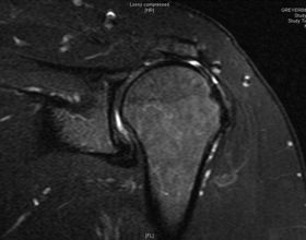 Figure 2 Demonstrates a large defect in the supraspinatus tendon.