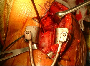 Figure 3 Visualization of superior portion of latissimus dorsi tendon