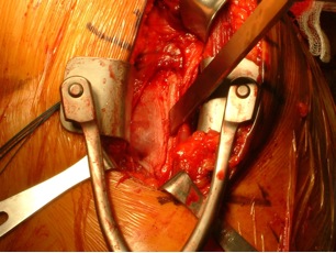 Figure 4 Osteotome at the insertion of the latissimus dorsi/teres major tendons