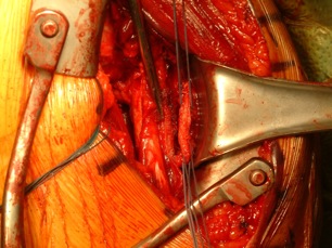 Figure 5 Approximation of latissimus dorsi/teres major tendon with pectoralis major tendon stump