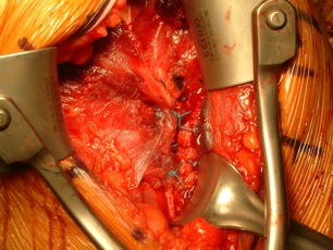 Figure 6 Final fixation of pectoralis major tendon back to tendon stump and incorporation of transferred latissimus dorsi/teres major tendons