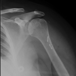 Figure 7 Post-operative view reveals improved glenoid/humeral head alignment
